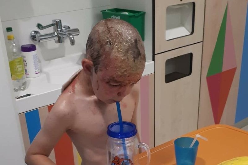 Szörnyű sérüléseket szenvedett a kisfiú, akire forrásban lévő víz borult