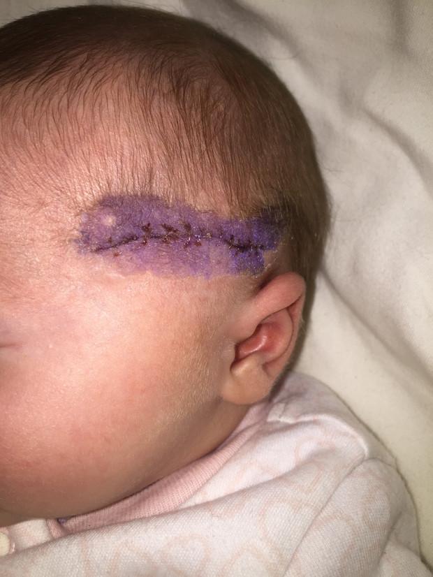 Rémálommá vált a szülés: császármetszés közben vágtak bele kislány fejébe